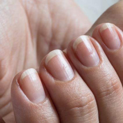 Understanding Onycholysis: Common Causes and Symptoms | What's Inside Matters
