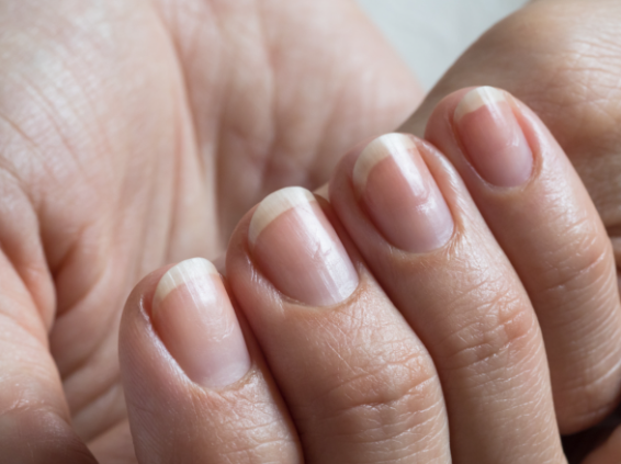 Understanding Onycholysis: Common Causes and Symptoms | What's Inside Matters